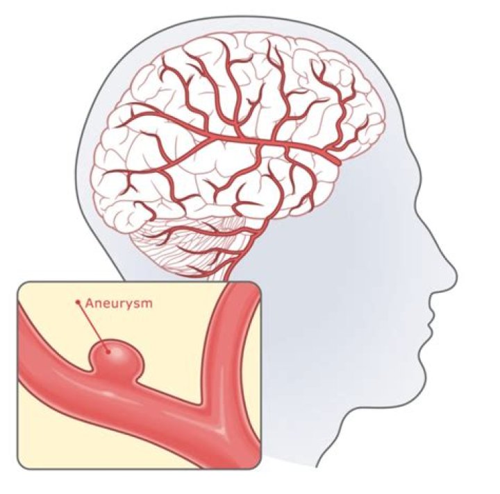 Are brain aneurysms hereditary?