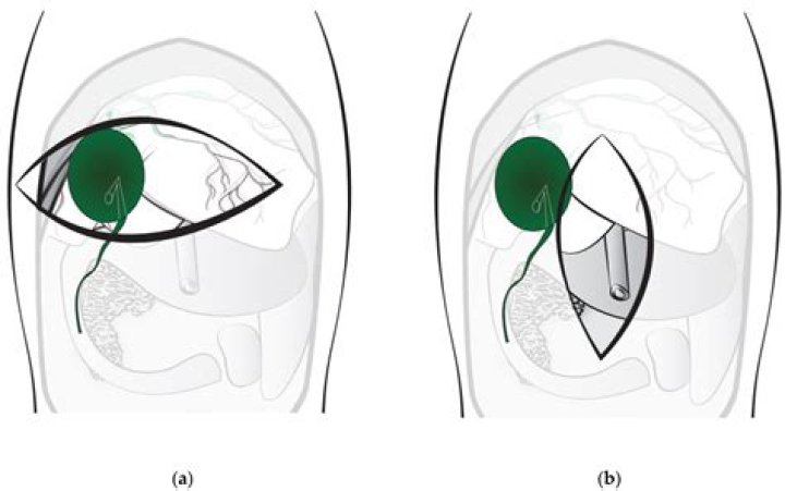 Are clips used in cholecystectomy?