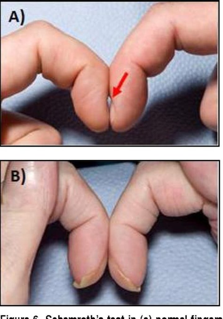 Are clubbed fingers genetic?