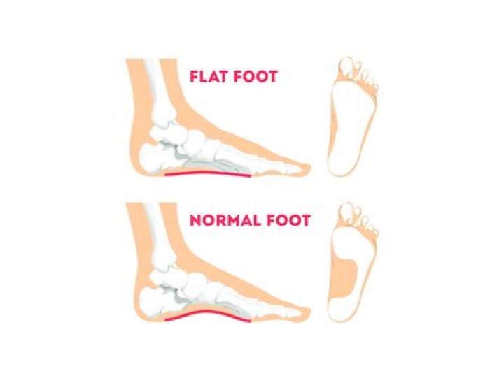 Are converse for flat feet?