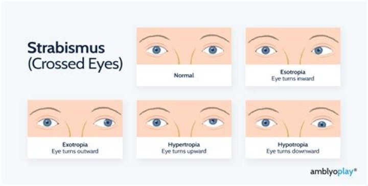 Are crossed eyes hereditary?