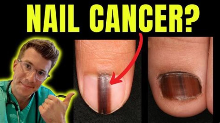 Are curling nails a sign of cancer?