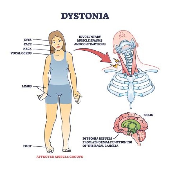 Are dystonia and parkinson related?