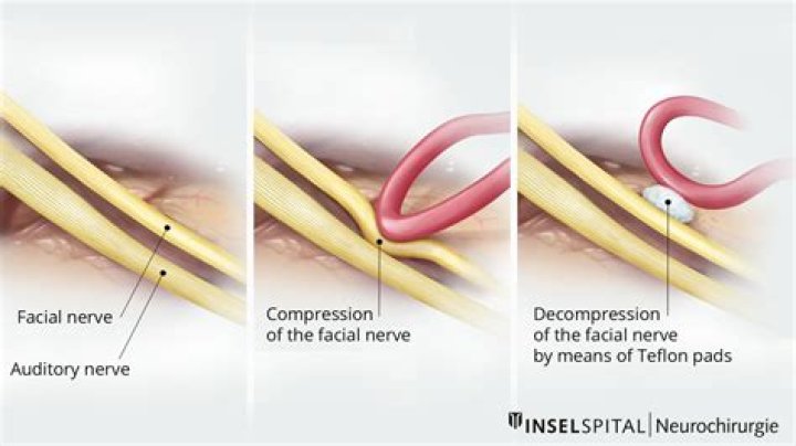 Are fasciculations common in ms?