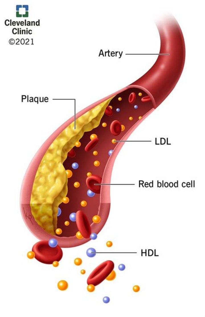 Are hypercholesterolemia and dyslipidemia the same?