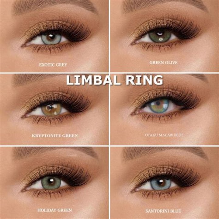 Are limbal rings rare?