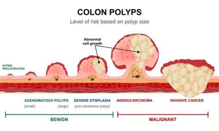 Are most polyps cancerous?