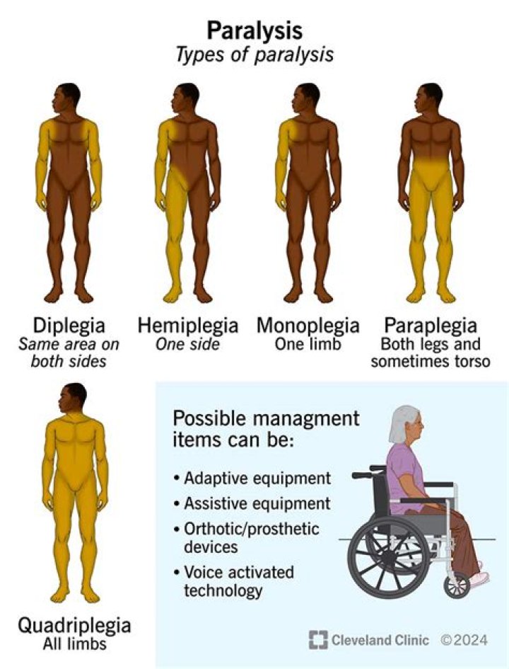 Are paraplegia and hemiplegia the same?
