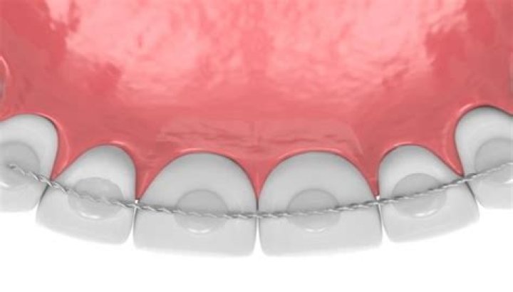 Are permanent retainers safe?