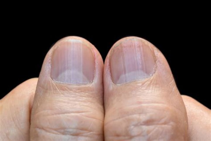Are ridges in fingernails normal?