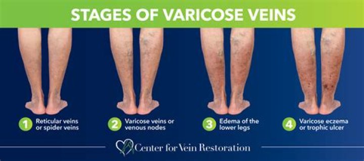 Are ropey veins dangerous?