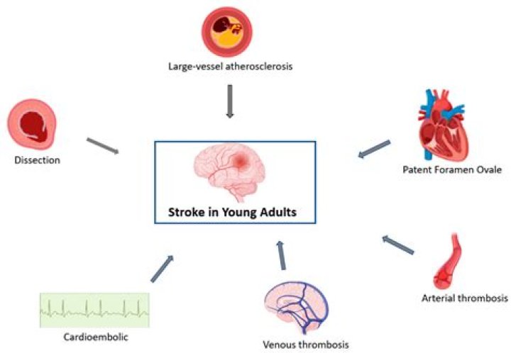 Are strokes common in young adults?
