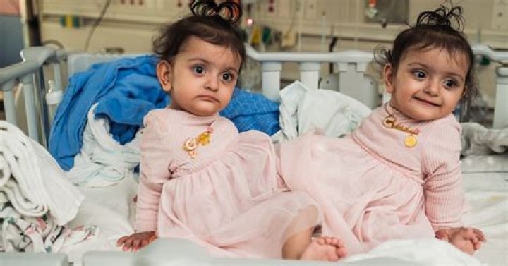 Are the savant twins still alive?