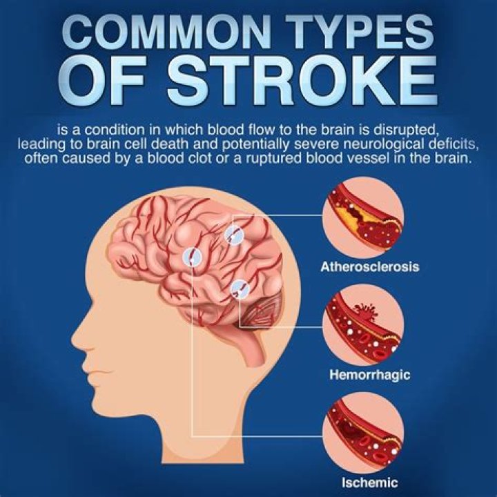 Are there symptoms leading up to a stroke?