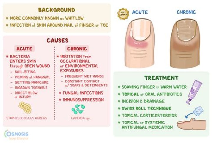 At home hangnail remedy?