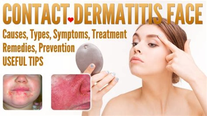 At home remedies for contact dermatitis?