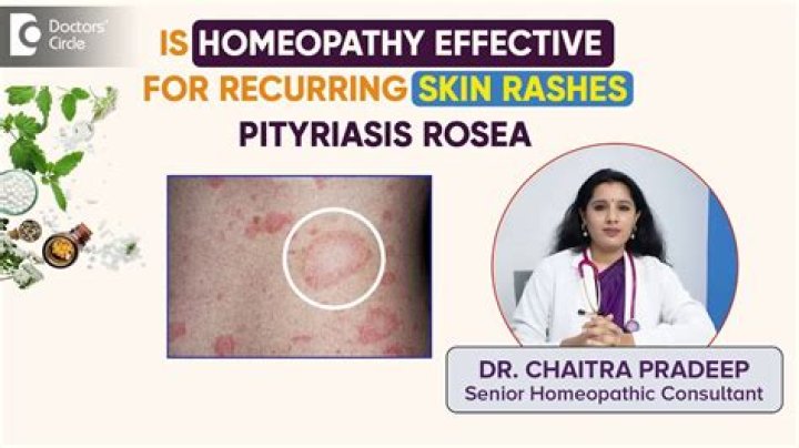 At home remedies for pityriasis rosea?