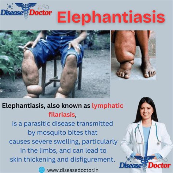 By whom elephantiasis spread?