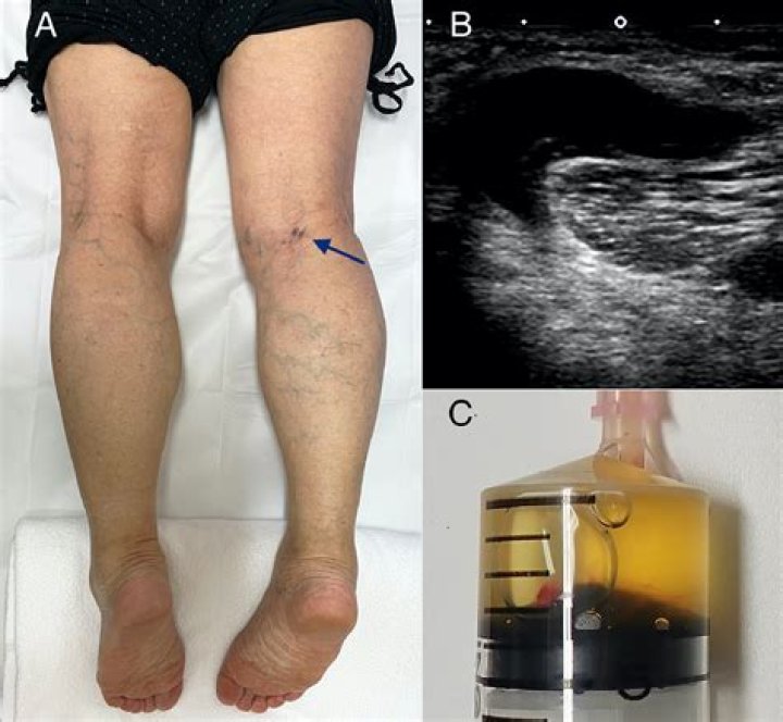 Can a baker's cyst cause a swollen leg?
