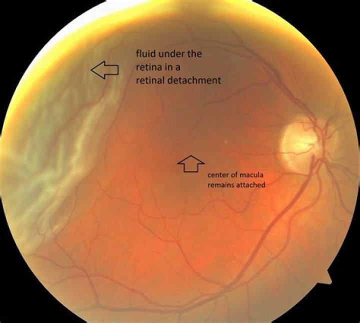 Can a detached retina be fixed?