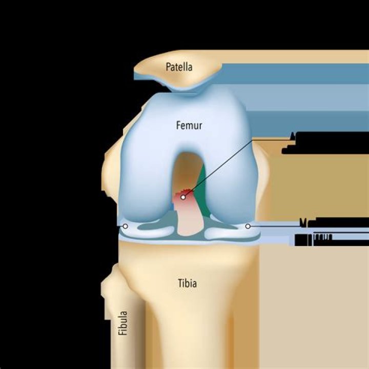 Can a dog injure an acl repair?