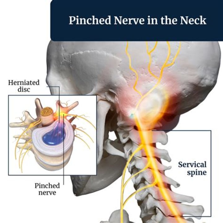 Can a pinched nerve cause earache?