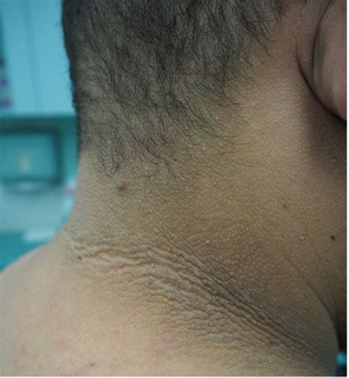 Can acanthosis nigricans come and go?