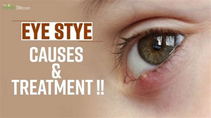 Can an eye stye make you sick?