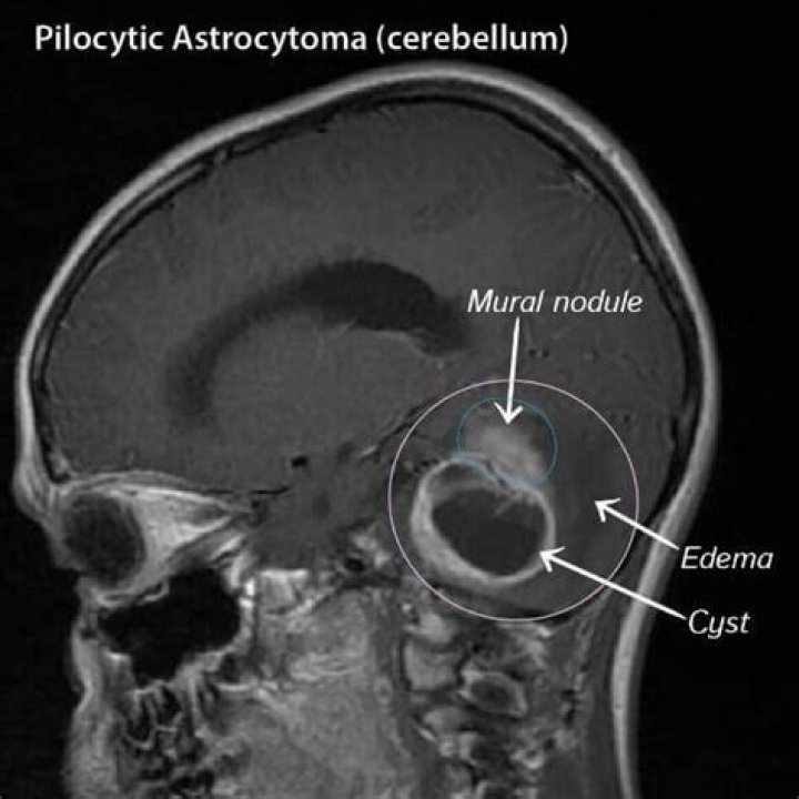 Can astrocytoma be benign?