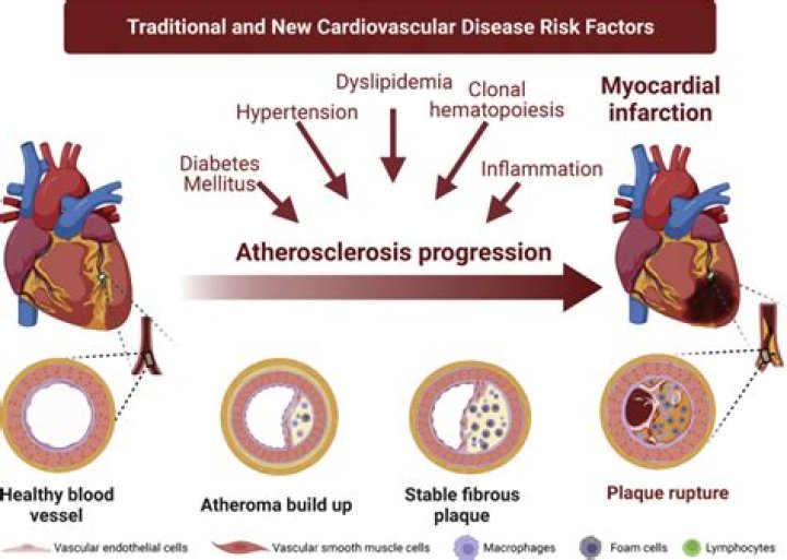 Can atherosclerosis be reversed naturally?
