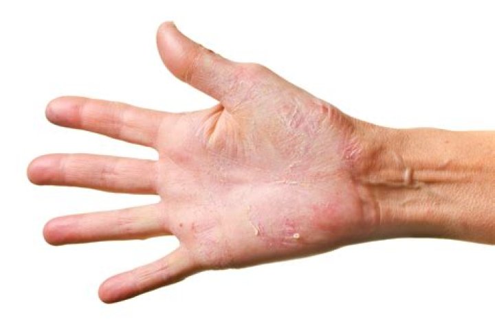 Can athlete's foot spread to hands?