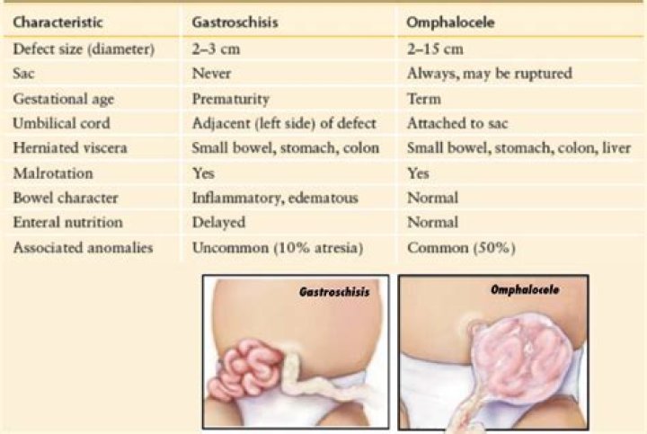 Can baby survive omphalocele?