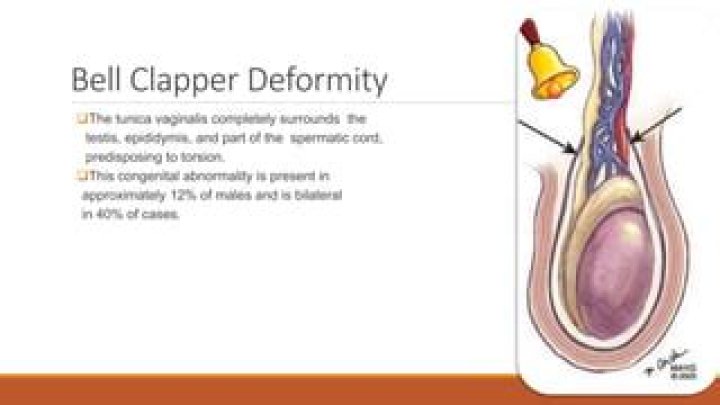 Can bell clapper deformity cause infertility?