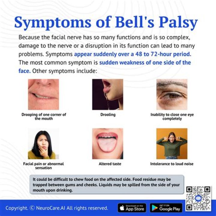 Can bell's palsy affect your tongue?