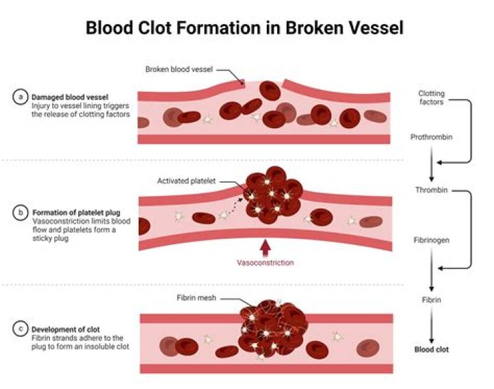 Can blood clots burst?