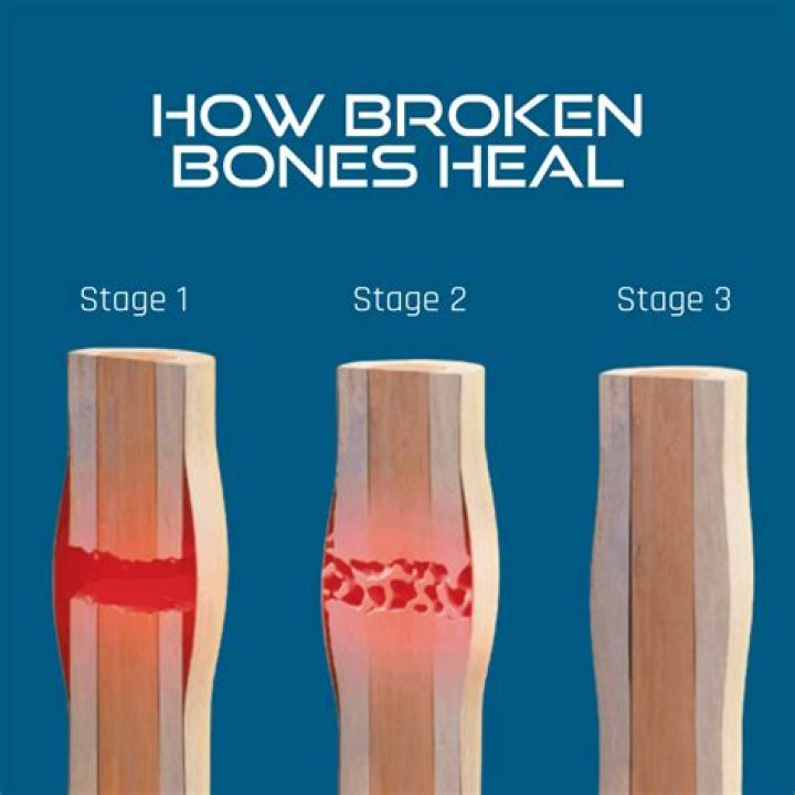 Can broken bones heal on their own?