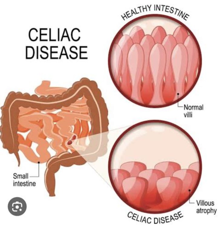 Can celiac disease cause cancer?