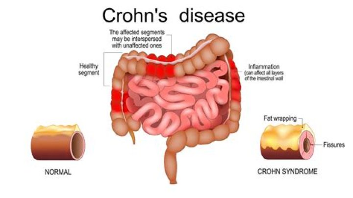 Can crohn's cause abscesses?