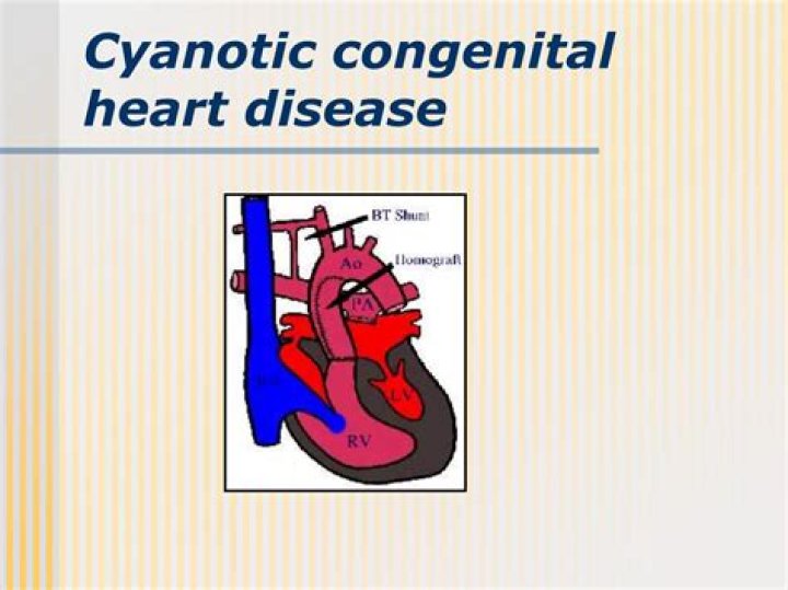 Can cyanotic heart disease be fatal?