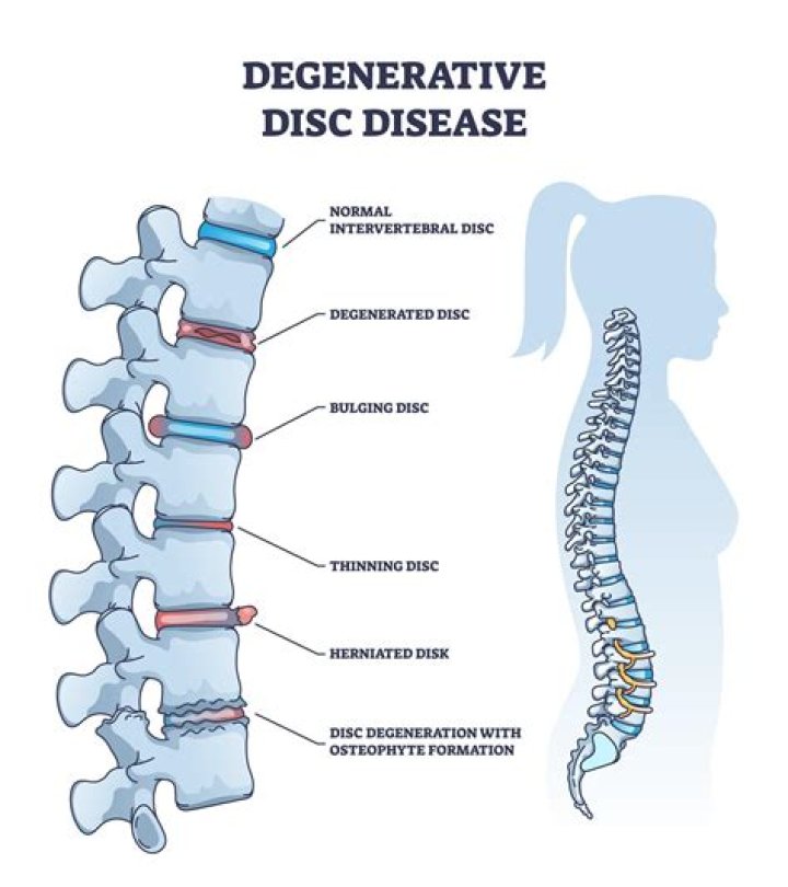 Can degenerative disc disease cripple you?