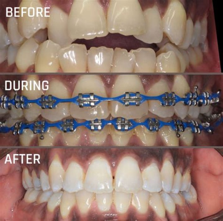Can denti cal cover braces?