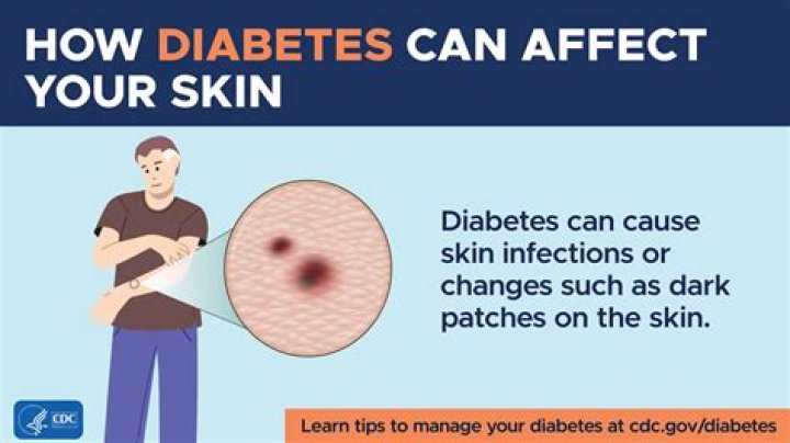 Can diabetes affect the integumentary system?