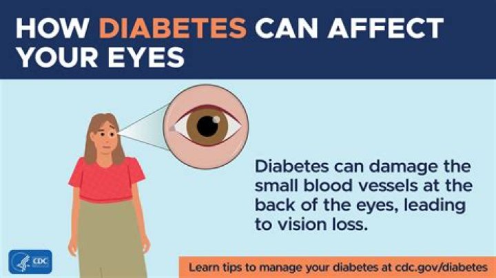 Can diabetes cause diplopia?