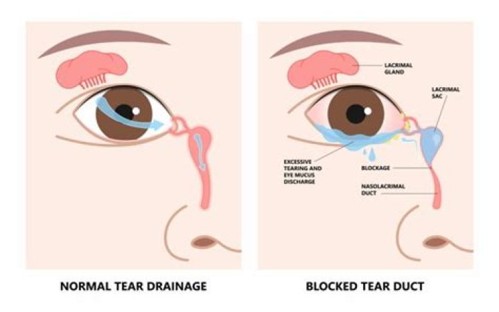 Can duct ectasia be unilateral?