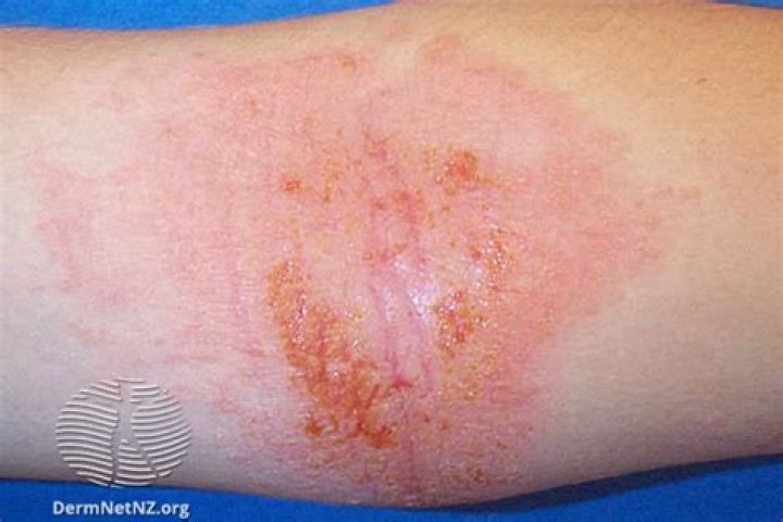 Can eczematous dermatitis be fatal?