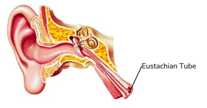 Can eustachian tube dysfunction cause tinnitus?