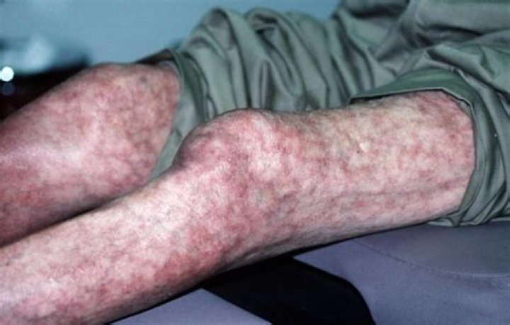 Can fever cause mottled skin?