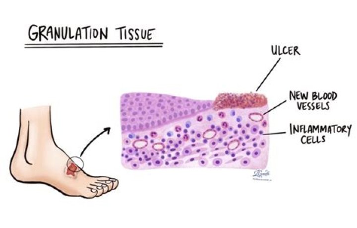 Can granulation tissue be painful?