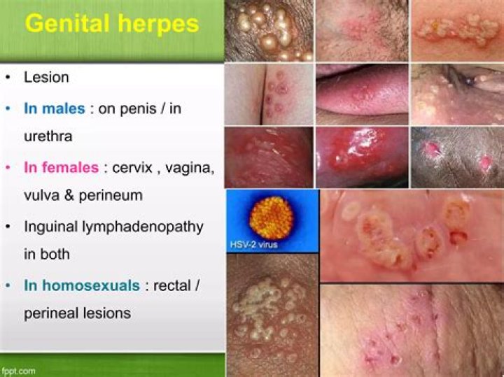Can herpes cause odor?