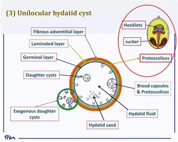 Can hydatid cyst be cured?